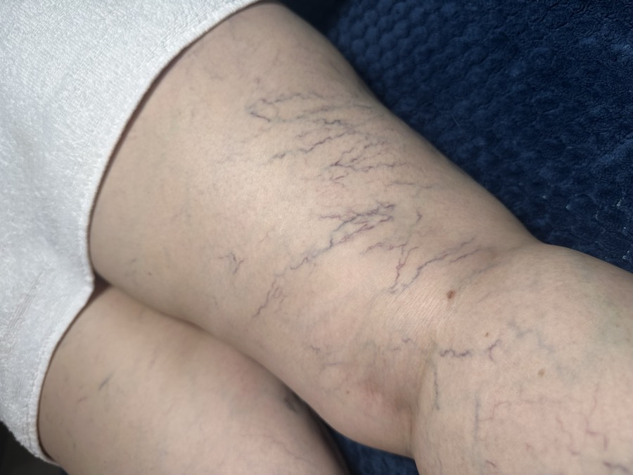 Escleroterapia